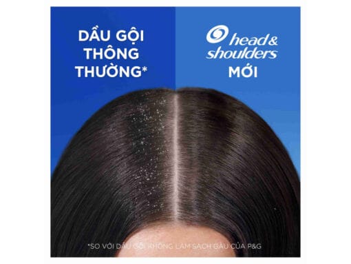 Dầu gội sạch gàu Head & Shoulders cho da đầu ngứa 625ml - Hình ảnh 5